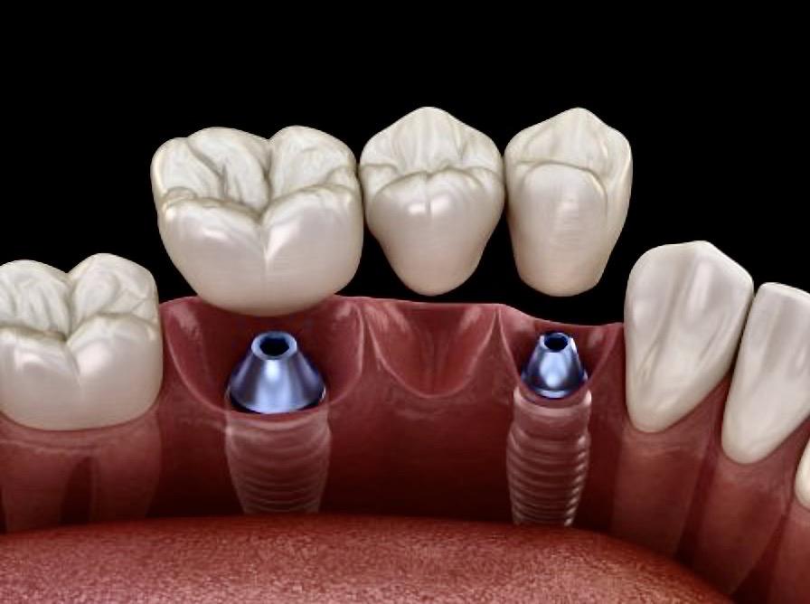 impianti dentali piacenza image11